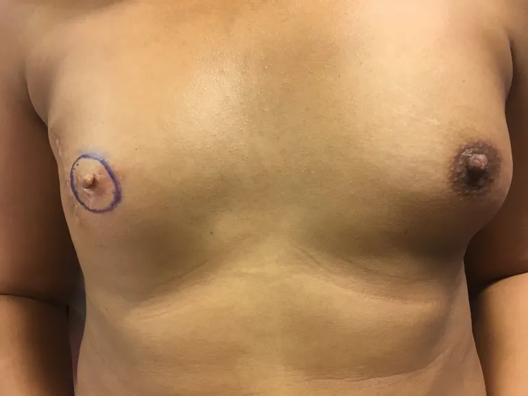 Opptegning av areola før tatovering