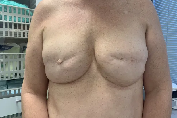 Pasienten skal få begge brystene tatovert