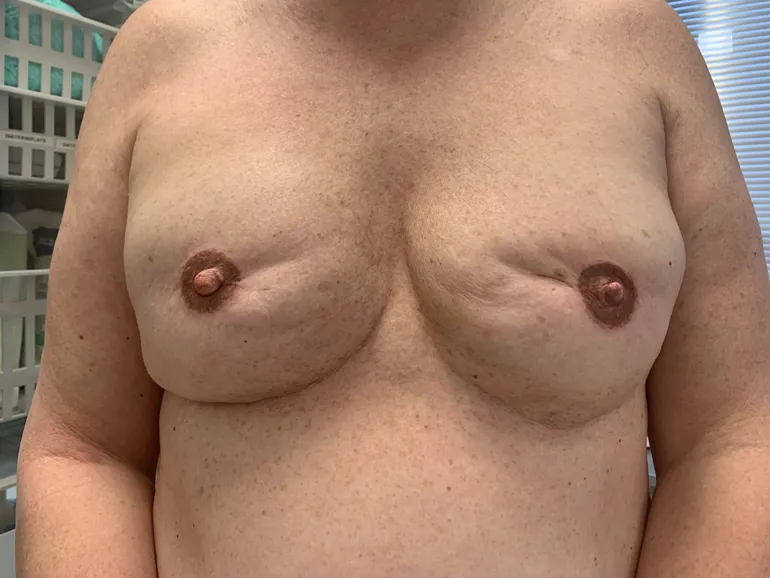 Begge brystene er tatovert