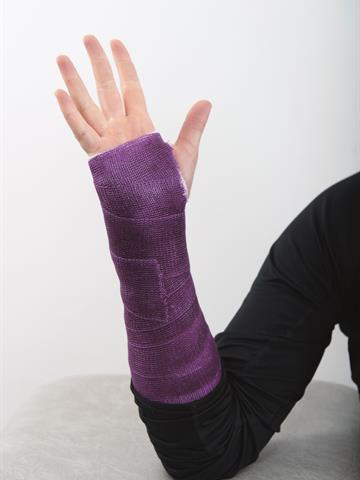 Gipset arm med sprikende hånd