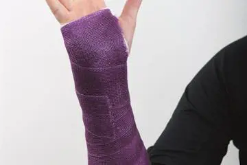 Gipset arm med sprikende hånd
