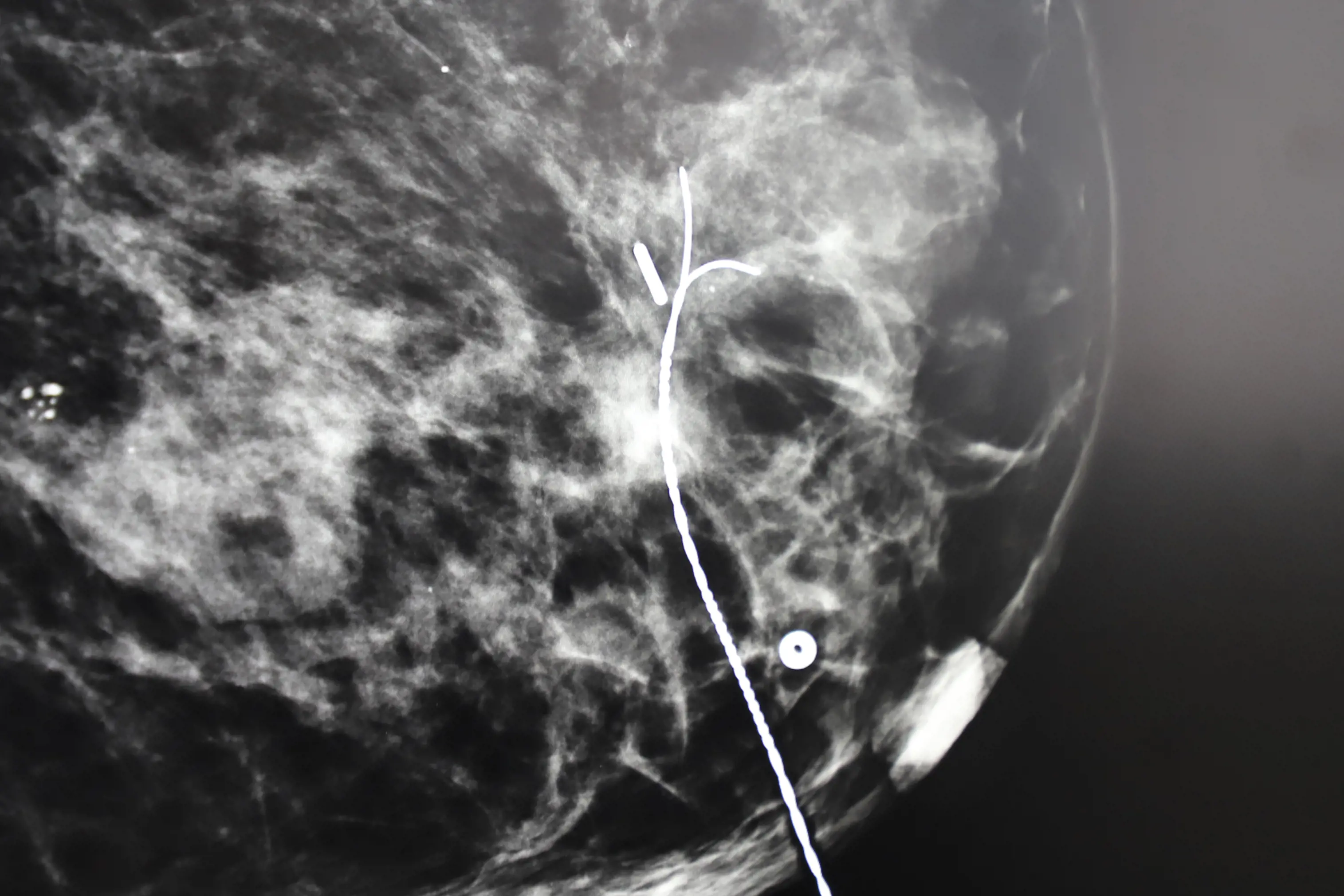 Røntgenbilde av et bryst med to markører.