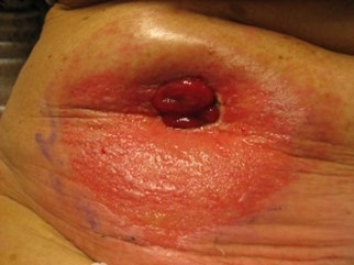 Stomi med hudreaksjon